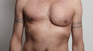 Nổ ngực vì bơm Silicon làm căng cơ bắp