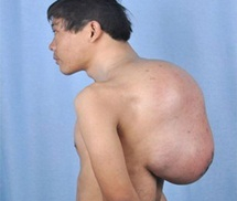 Chàng trai mất ăn, mất ngủ vì mang khối u 13kg trên lưng