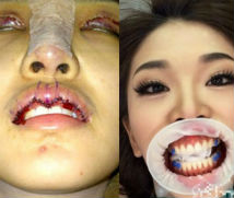 Ghê rợn vết tích phẫu thuật thẩm mỹ của người đẹp Thái Lan