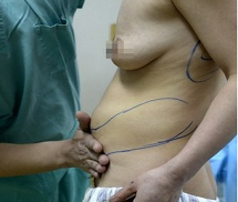 Ngực nhân tạo 'chạy' xuống bụng và lưng vì phẫu thuật hỏng