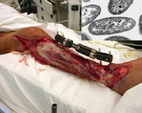Hãi hùng hình ảnh cắt bỏ chân tay, da mặt vì vi khuẩn ăn thịt người