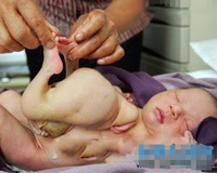 Xót thương bé trai sơ sinh có 4 tay, 4 chân trên cơ thể