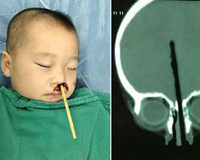 Cha mẹ bất cẩn, bé trai 2 tuổi bị đũa chọc từ mũi lên não