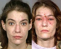 Cận cảnh những khuôn mặt biến dạng kinh hoàng vì dùng ma túy
