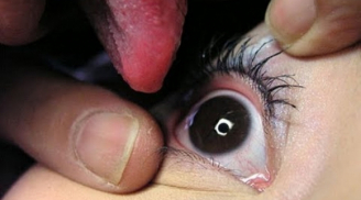 Liếm nhãn cầu bệnh nhân để chữa bệnh về mắt