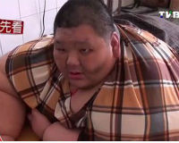 Choáng: Người đàn ông Châu Á phẫu thuật giảm 200kg thịt
