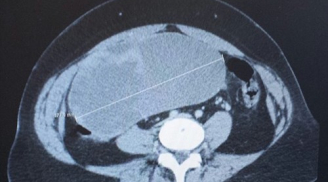 Kinh hoàng: Phát hiện khối u to như quả bóng trong tử cung