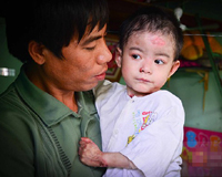 Kỳ lạ: 2 em bé bị bệnh tự “bốc cháy” ở Bình Dương