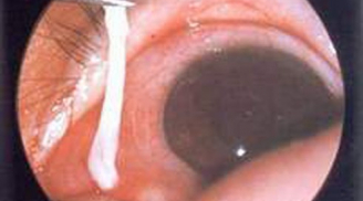 Sán ngoe nguẩy trong mắt vì chữa đau mắt kiểu kinh dị