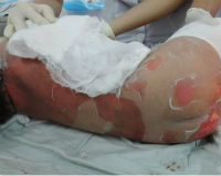 Xót thương bé 2 tuổi bị lột da vì đắp lá chữa bỏng