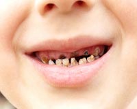 Cách đề phòng hiện tượng 'răng sún' ở trẻ mẹ nên biết