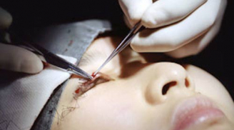 Cận cảnh quá trình cắt mí mắt nhiều đau đớn