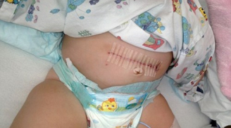 Kỳ lạ bé 10 ngày tuổi bị ung thư buồng trứng