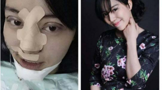 Hotgirl Việt thẩm mỹ toàn bộ khuôn mặt vì sợ chồng 'chán'