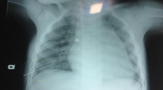 Mẹ bất cẩn để con 3 tuổi bị kim đâm thủng phổi