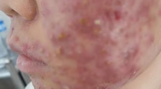 Kinh hoàng: Mặt nát bét vì uống collagen làm đẹp da
