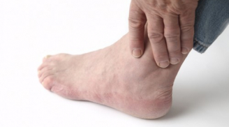 Biểu hiện chứng tỏ bạn có nguy cơ mắc bệnh gout