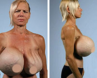 Cắt bỏ bộ ngực nặng gần 14kg do phẫu thuật thẩm mỹ hỏng