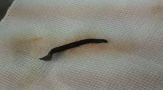 Kinh hoàng: Gắp con đỉa 4,5cm trong mũi bệnh nhân