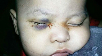Bác sĩ phẫu thuật nhầm, bé trai 1 tuổi bị mù mắt