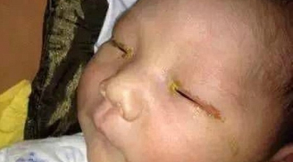 Đau lòng: Bé 3 tháng tuổi mù một mắt do chụp ảnh bật đèn flash
