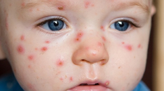 Nguyên nhân và cách phòng chống bệnh thủy đậu ở trẻ em