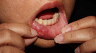 Nguyên nhân và cách điều trị nhiệt miệng ở người lớn