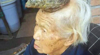 Kinh hãi cụ bà 87 tuổi mọc sừng “khủng” trên đầu