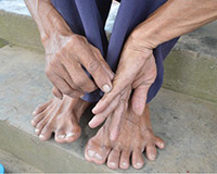 Người đàn ông có 25 ngón tay, chân ở Đồng Tháp