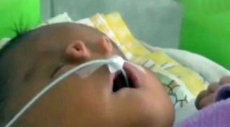 Xót xa bé trai chào đời với 4 lỗ mũi trên mặt