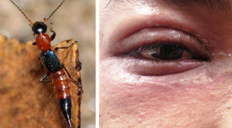 Tại sao không giết kiến ba khoang là cách để bảo vệ cơ thể bạn?
