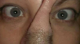 Kì lạ: Chiếc mũi có một không hai được cấy ghép từ da đầu
