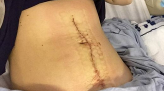 Thiếu nữ 21 tuổi bất ngờ bị nổ tung bụng như phim kinh dị
