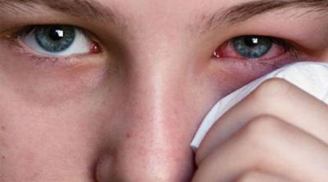 Mẹo chữa đau mắt đỏ tức khắc không cần tới thuốc tây