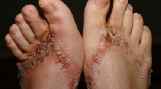 Giày dép Trung Quốc chứa hóa chất độc hại, gây lở loét chân