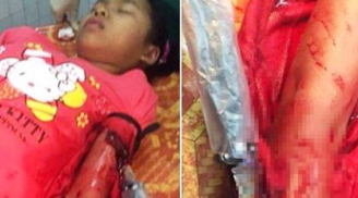 Bé gái 12 tuổi bị kẻ bịt mặt găm dao vào tay đêm Noel