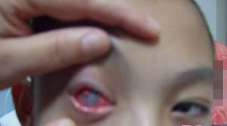 Cậu bé 10 tuổi bị mù vì trót nghịch đèn laser