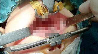 Xót xa bé 1 tuổi bị thương nặng do cục pin phát nổ trong miệng