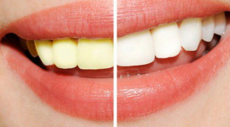 Phương pháp làm trắng răng vô hại nhất bạn nên dùng
