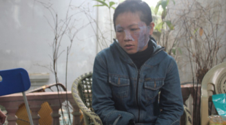 Kinh hoàng chồng nướng đỏ bát inox tra tấn vợ ở Nghệ An