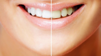 Loại bỏ cao răng siêu tốc chỉ 1 phút, sở hữu nụ cười không tỳ vết