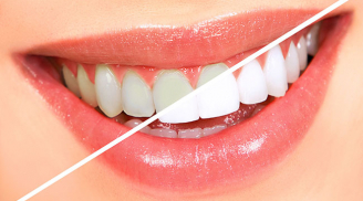 Tự lấy cao răng ở nhà chỉ 1 phút, không tốn tiền đảm bảo hiệu quả