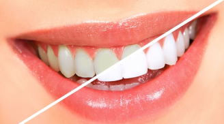 Mẹo giúp răng sáng bóng sau 2 phút cho những người sợ đi nha sĩ