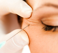 Những thắc mắc xoay quanh phương pháp tiêm botox căng da mặt