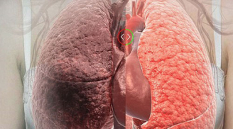 Thanh lọc phổi cho người có thâm niên thuốc lá trên 10 năm