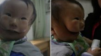 Đau buồn đứa bé có khuôn mặt 'quỷ' khiến mọi người khiếp sợ