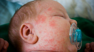 Dấu hiệu nhận biết khi trẻ bị sốt phát ban