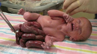 Bé sơ sinh với phần nội tạng nằm ngoài cơ thể phải bọc giấy bóng