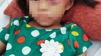 Lên án: Bé gái 7 tuổi nghi bị mẹ kế bạo hành tàn nhẫn, gây bỏng