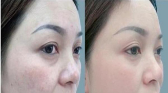 Chỉ với 1 quả chanh làm đơn giản theo cách này tàn nhang sẽ không còn là nỗi lo